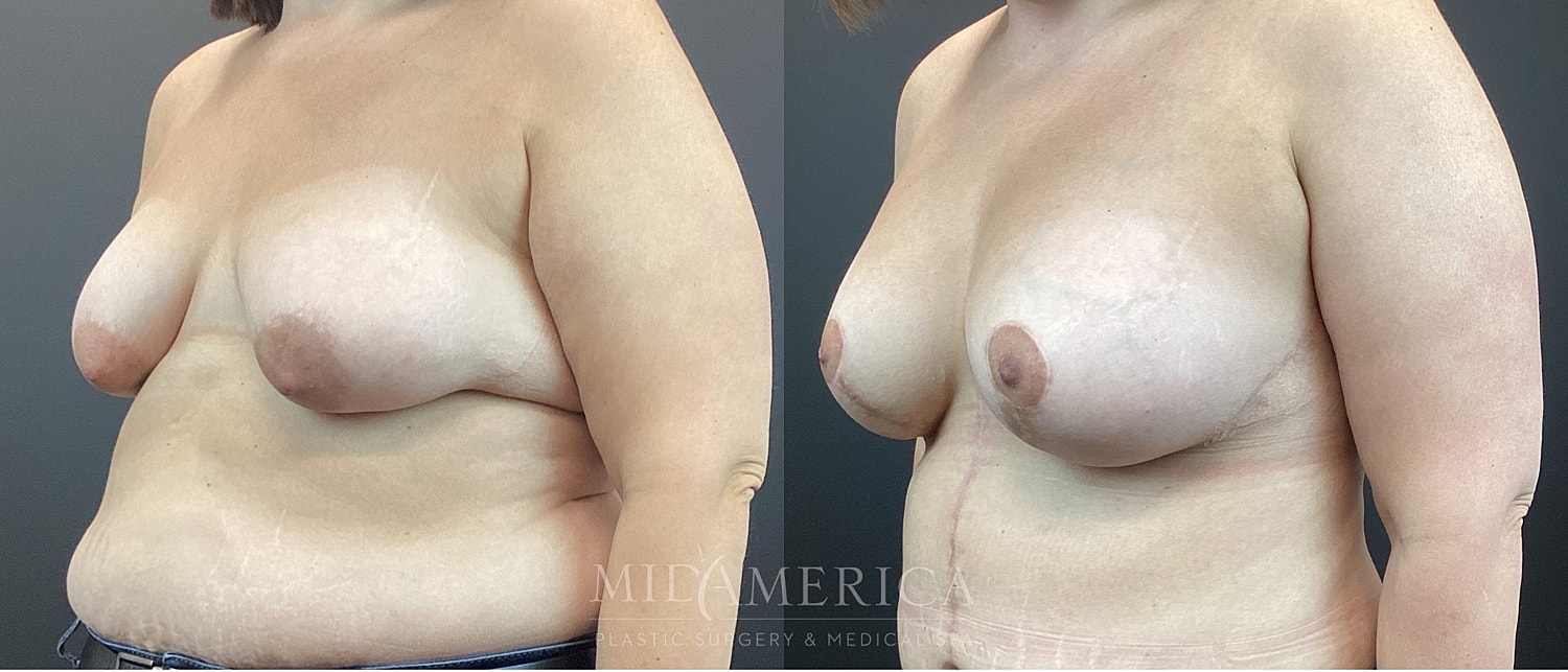 Breast Augmentation & Lift Before & After