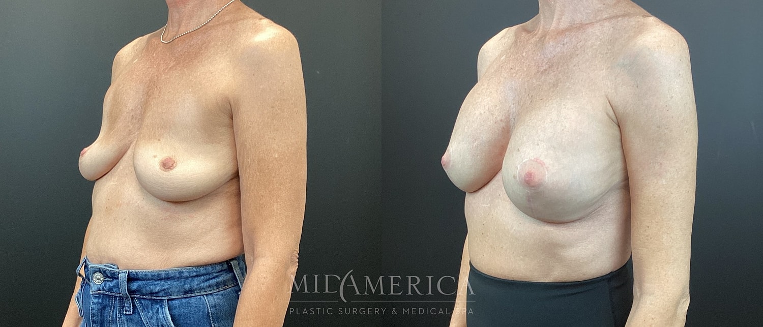 Breast Augmentation & Lift Before & After