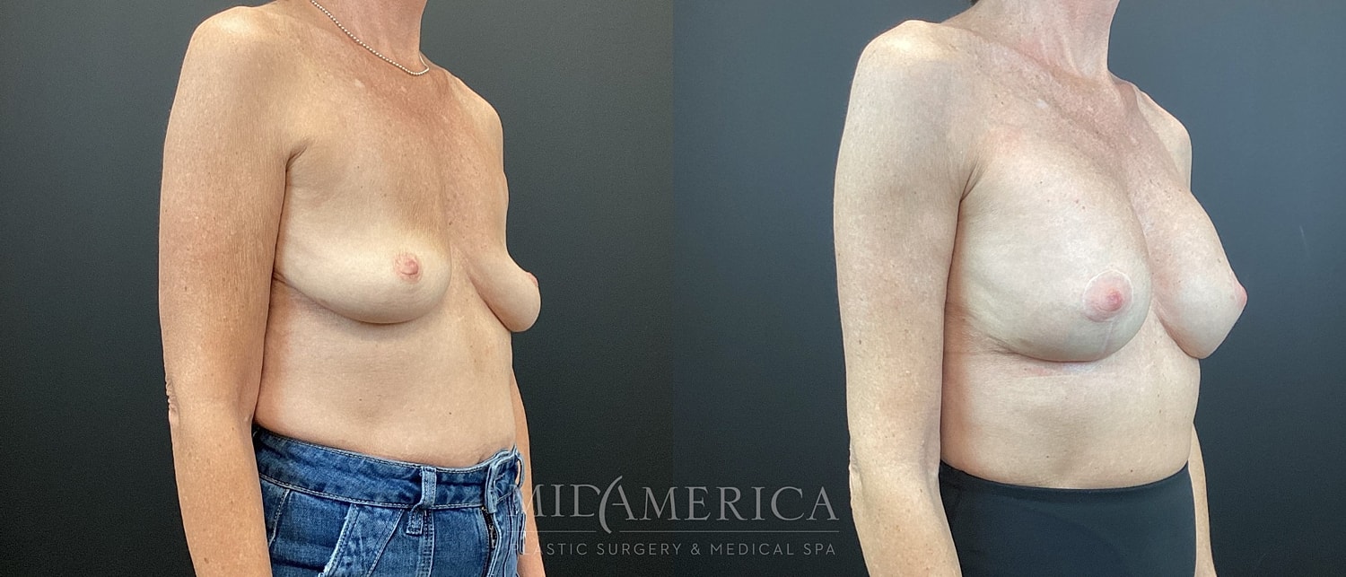 Breast Augmentation & Lift Before & After