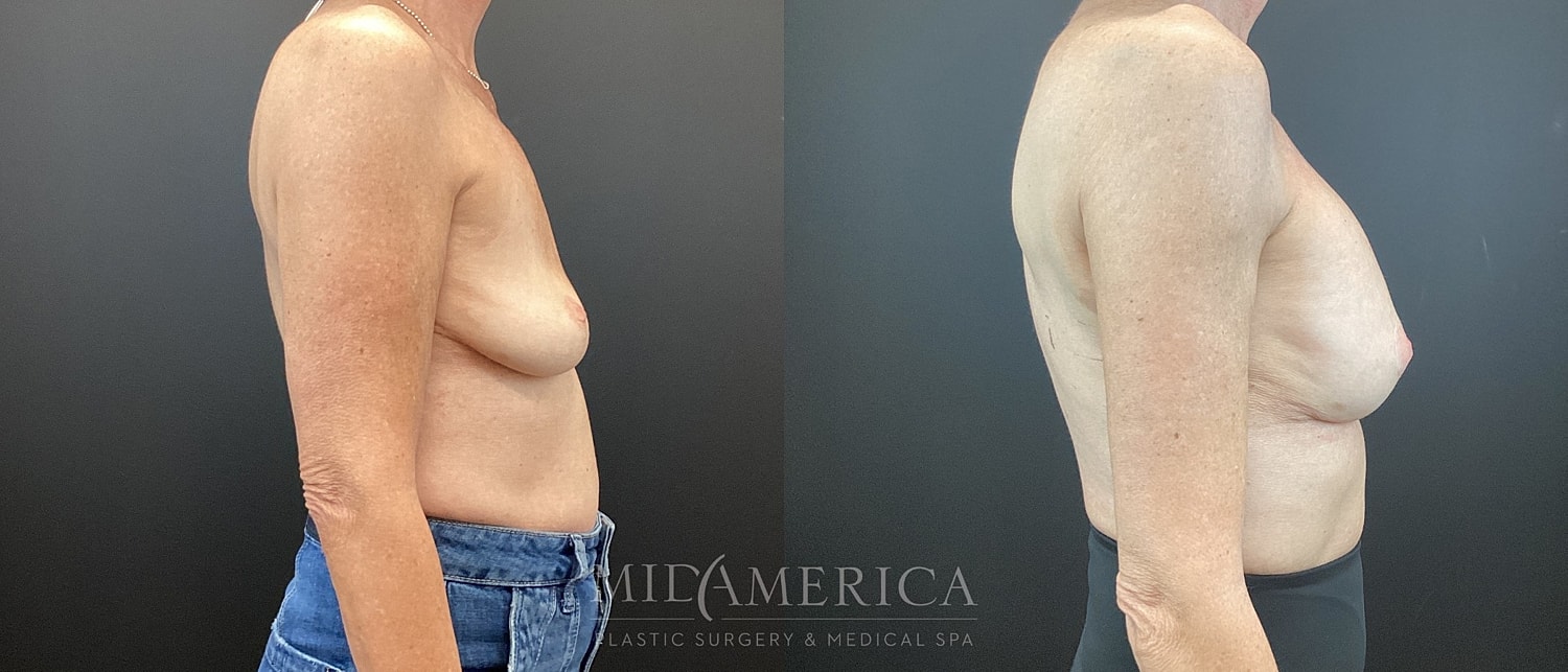 Breast Augmentation & Lift Before & After