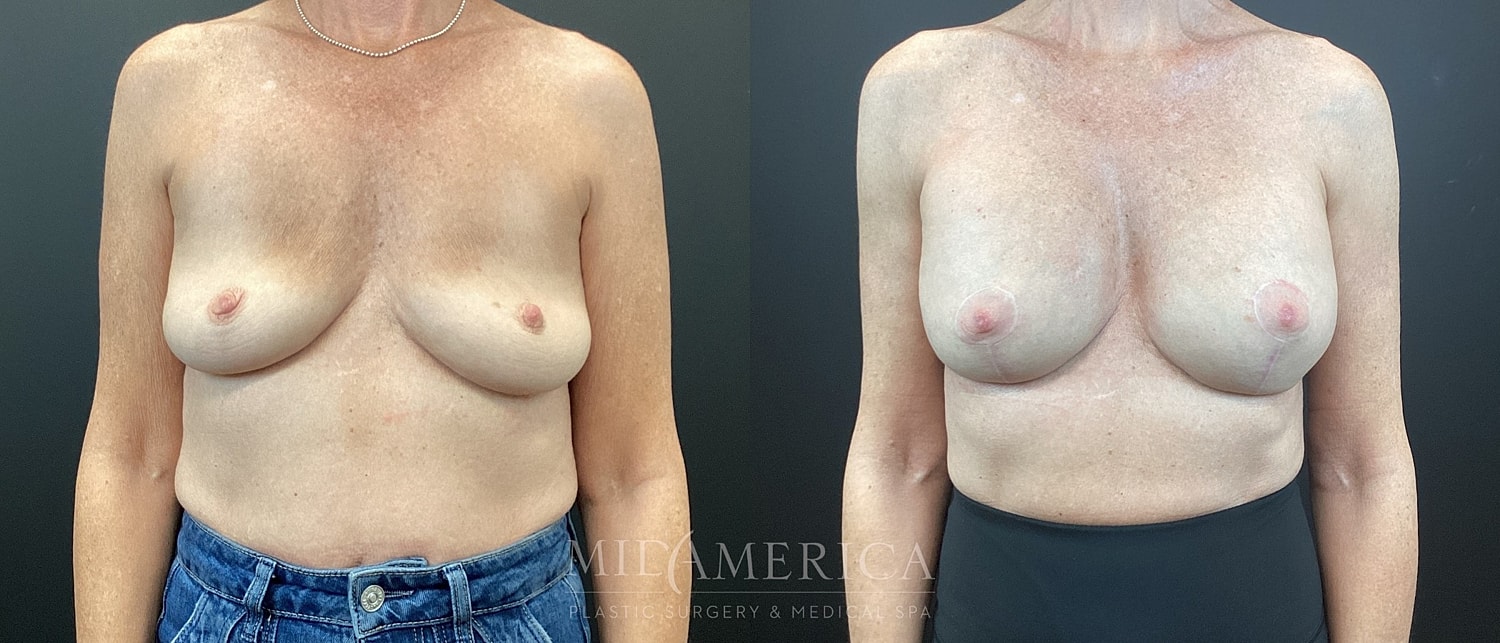 Breast Augmentation & Lift Before & After