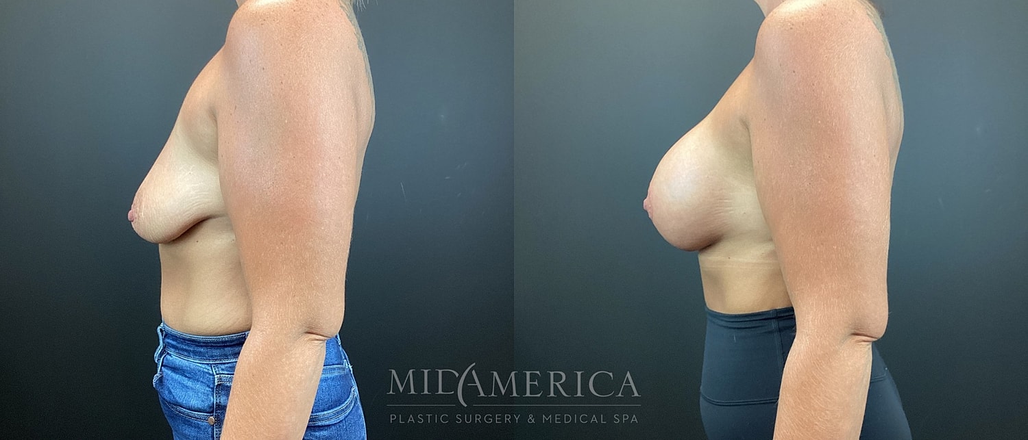 Breast Augmentation & Lift Before & After