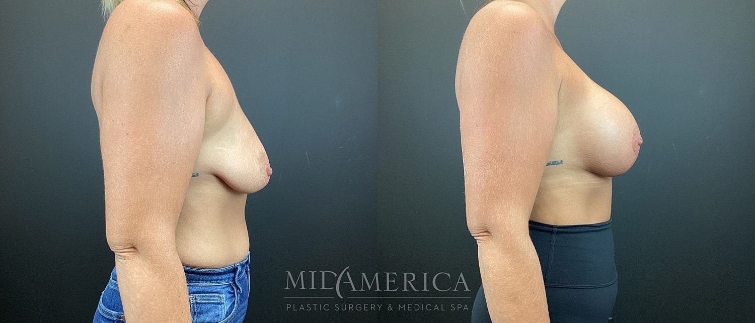 Breast Augmentation & Lift Before & After