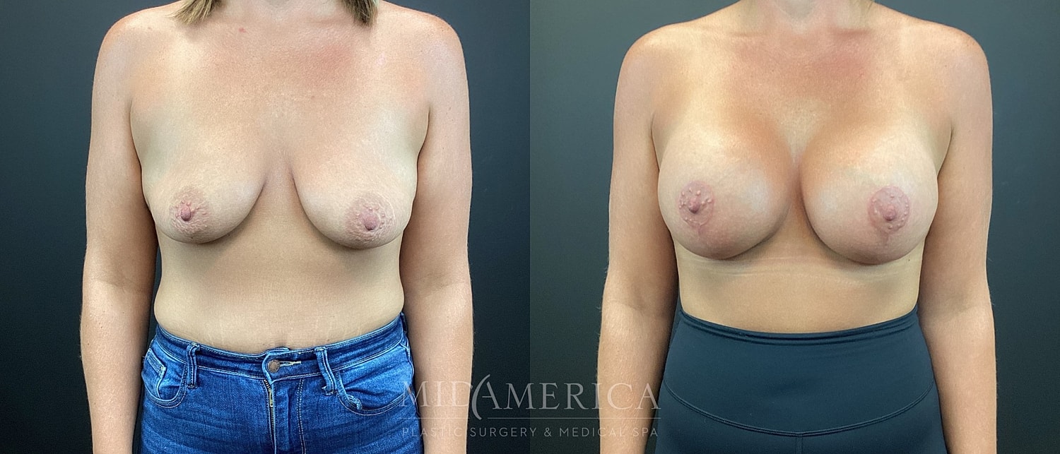 Breast Augmentation & Lift Before & After
