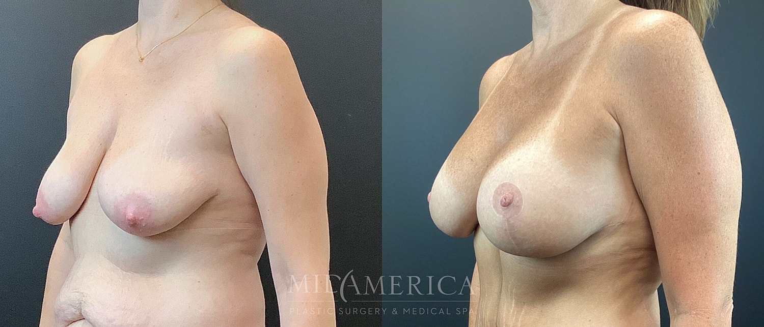 Breast Augmentation & Lift Before & After