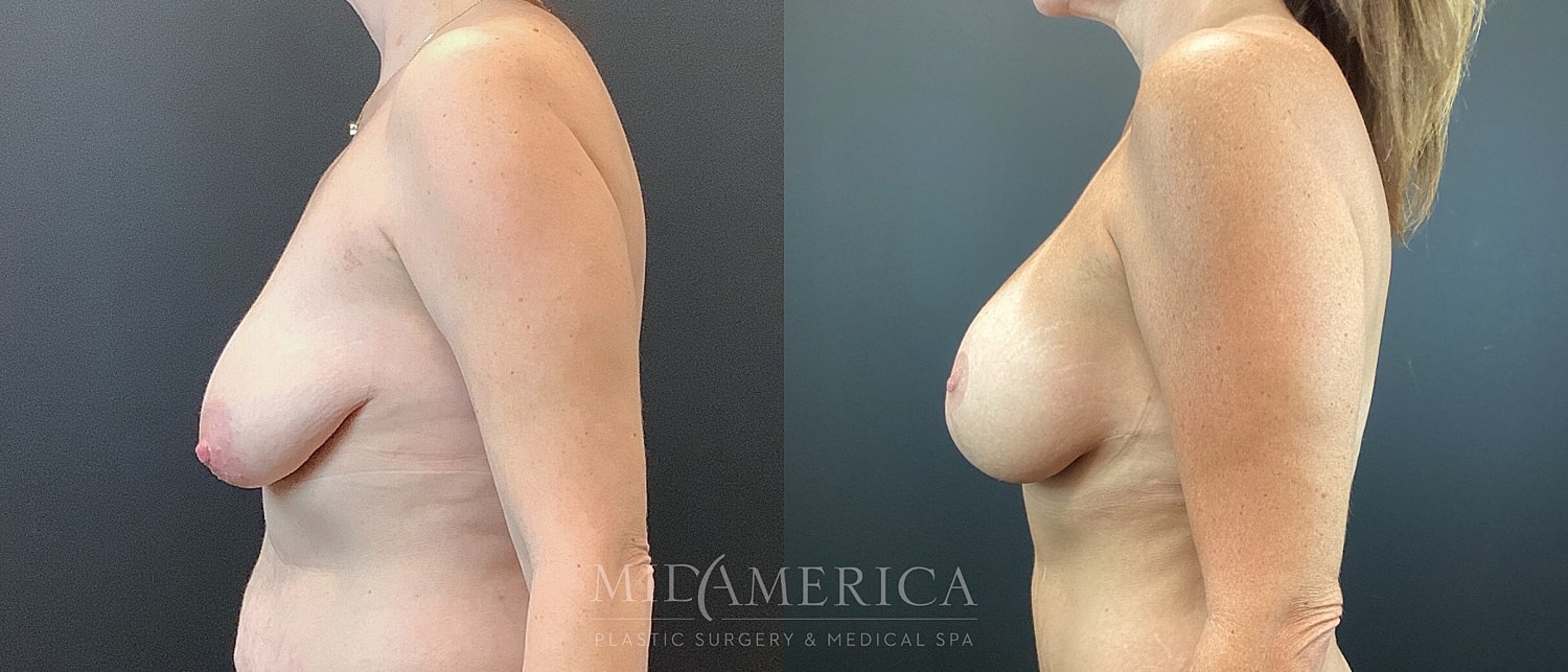 Breast Augmentation & Lift Before & After