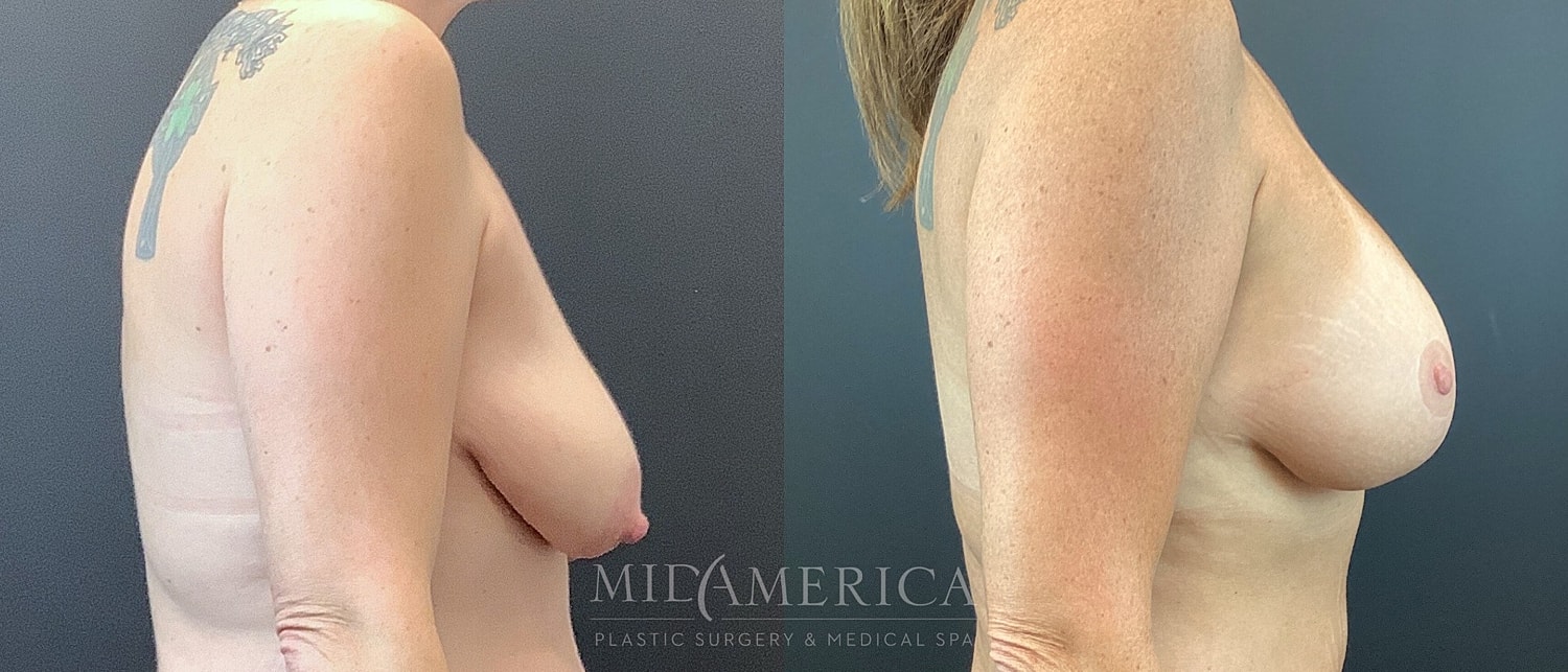Breast Augmentation & Lift Before & After