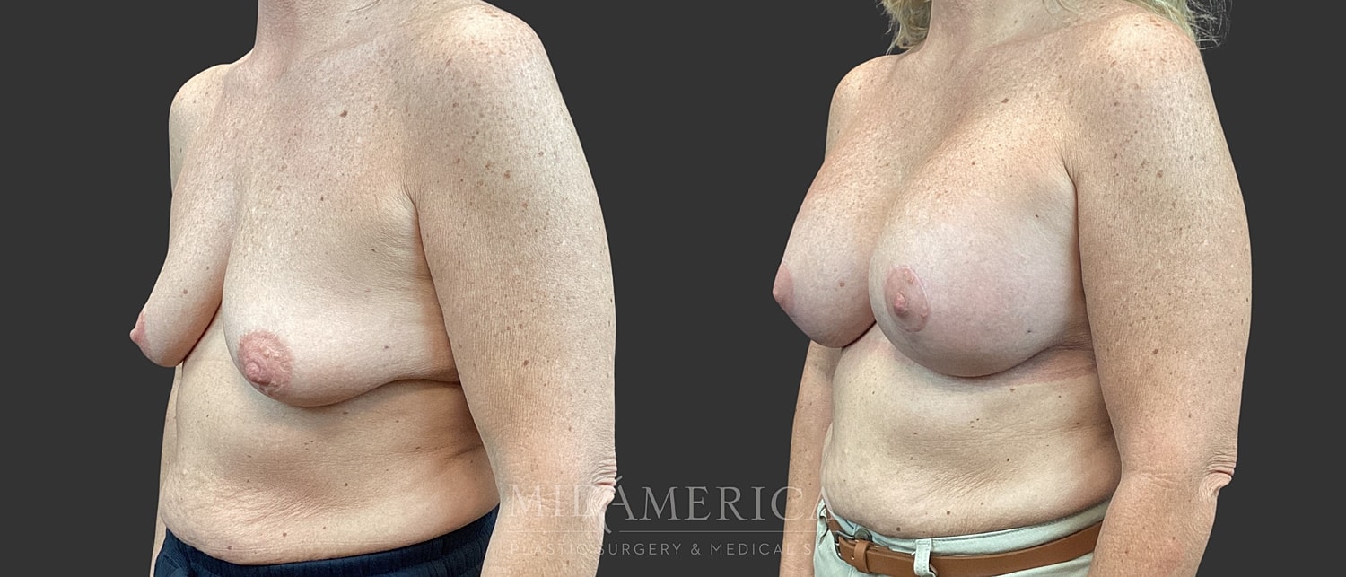 Breast Augmentation & Lift Before & After