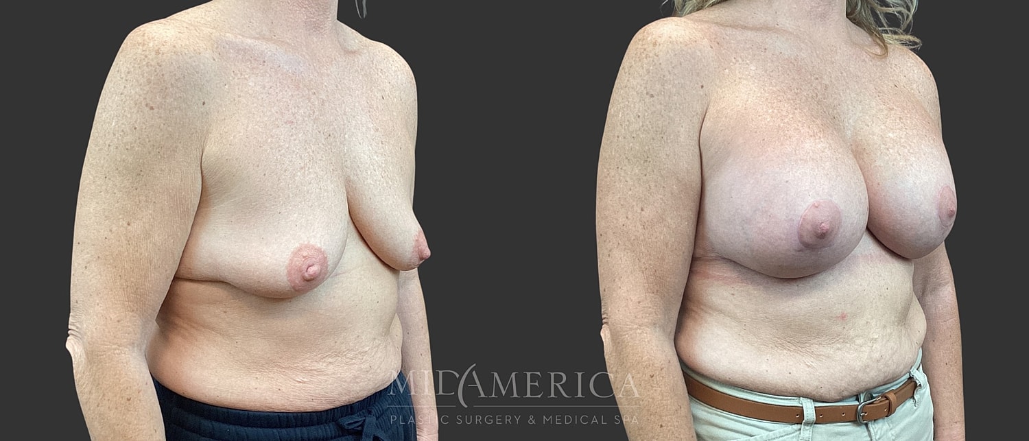 Breast Augmentation & Lift Before & After