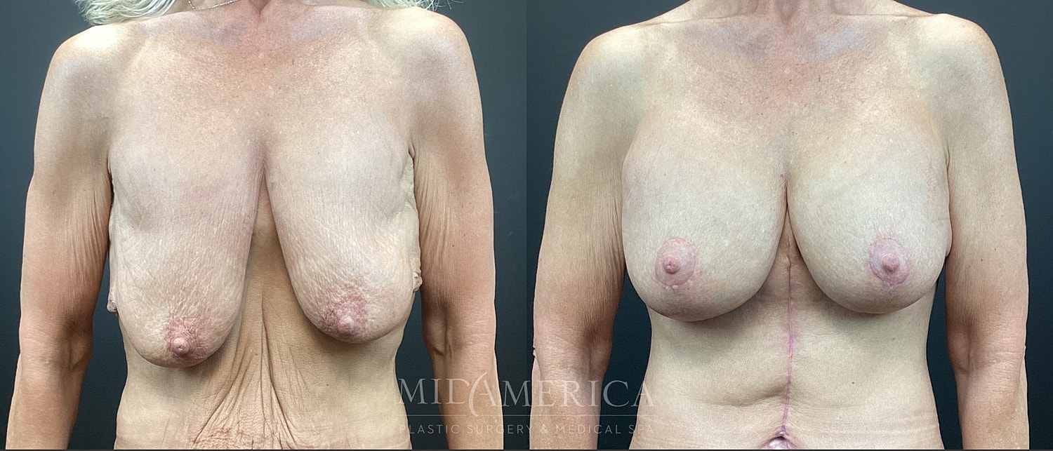 Breast Augmentation & Lift Before & After