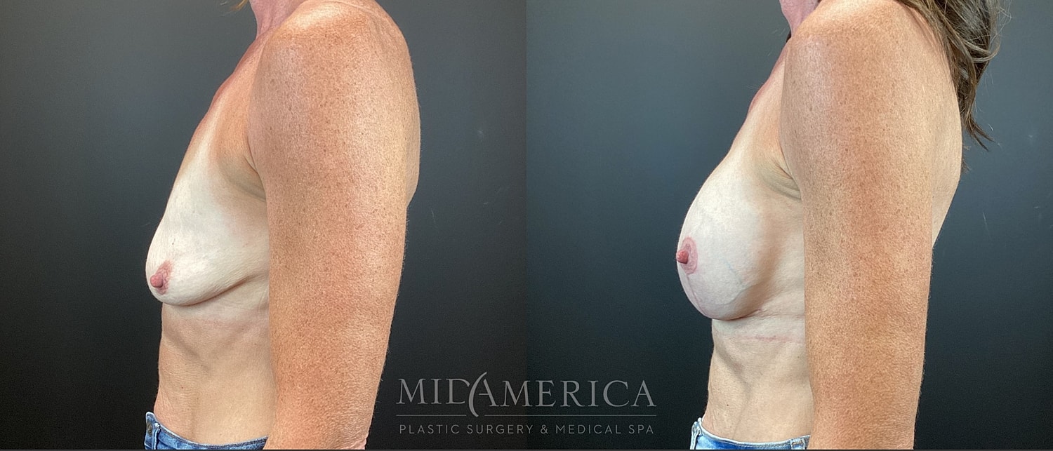 Breast Augmentation & Lift Before & After