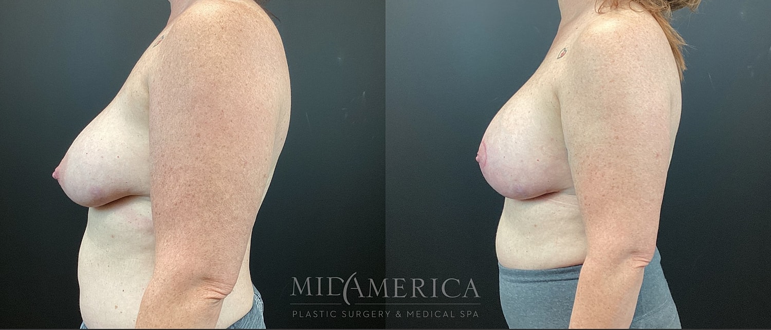 Breast Augmentation & Lift Before & After