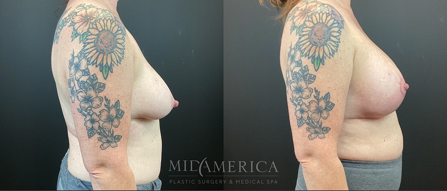 Breast Augmentation & Lift Before & After