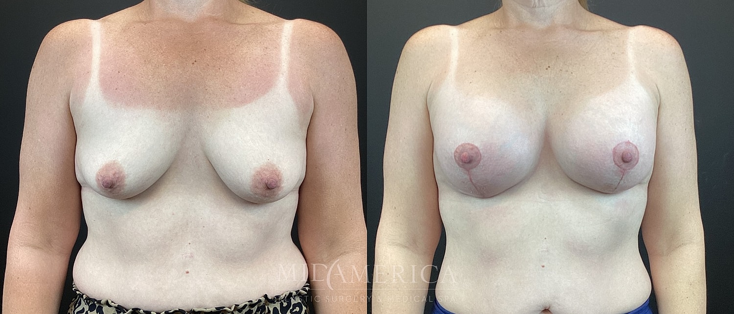 Breast Augmentation & Lift Before & After