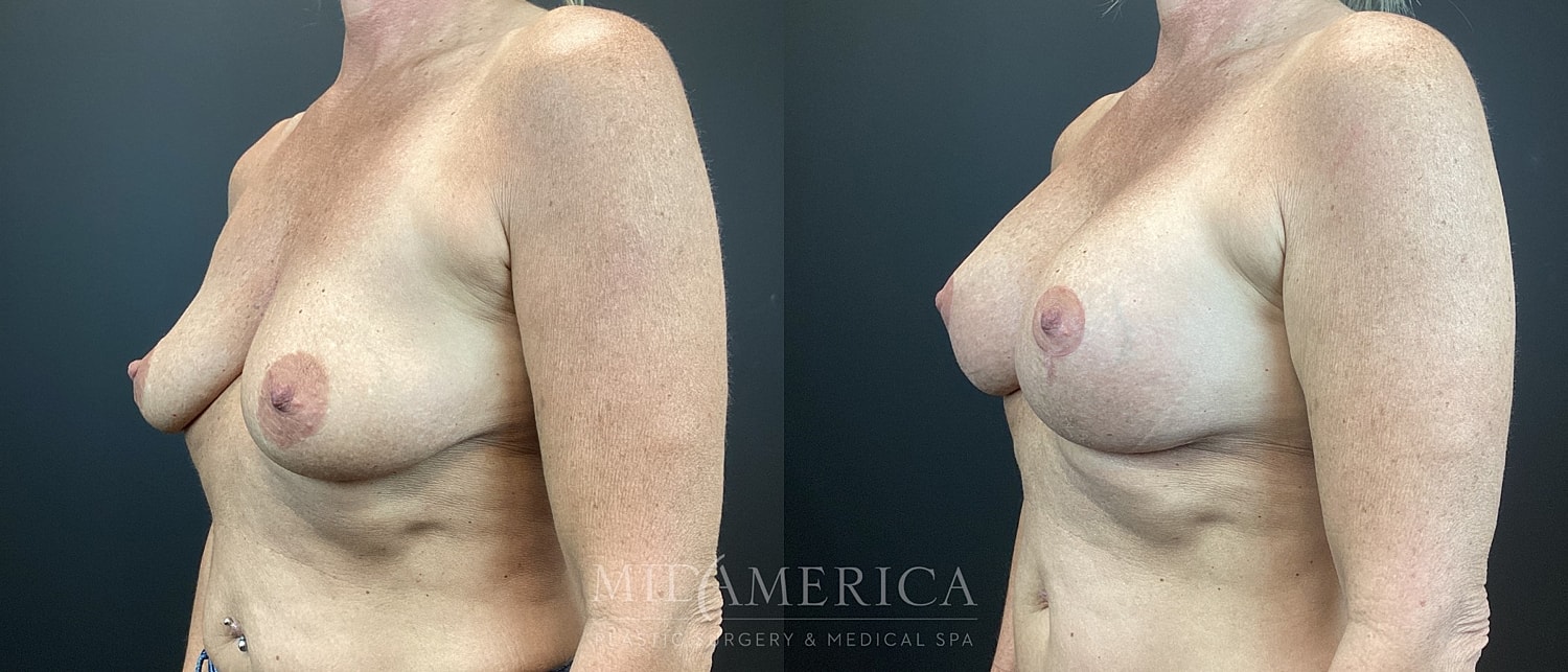 Breast Augmentation & Lift Before & After