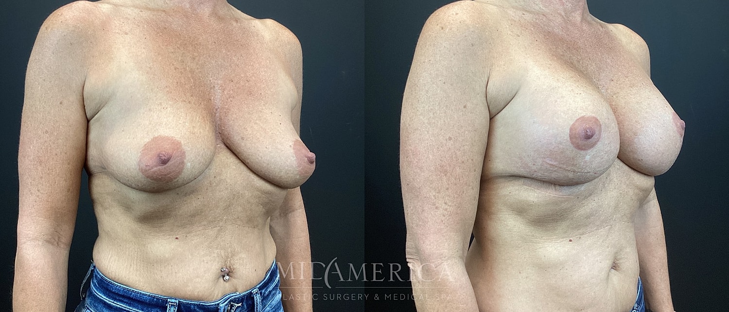 Breast Augmentation & Lift Before & After