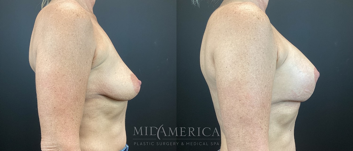 Breast Augmentation & Lift Before & After
