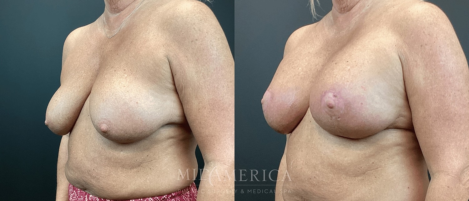 Breast Augmentation & Lift Before & After