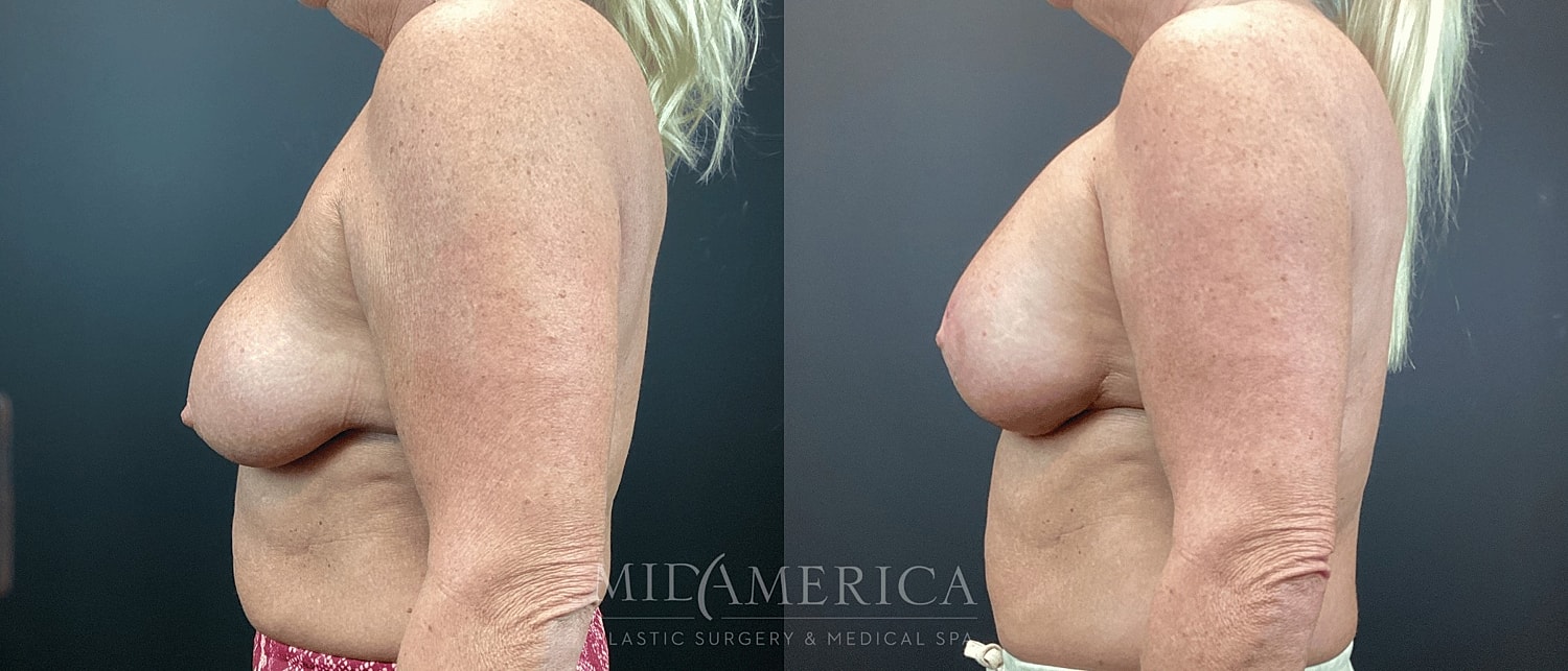 Breast Augmentation & Lift Before & After