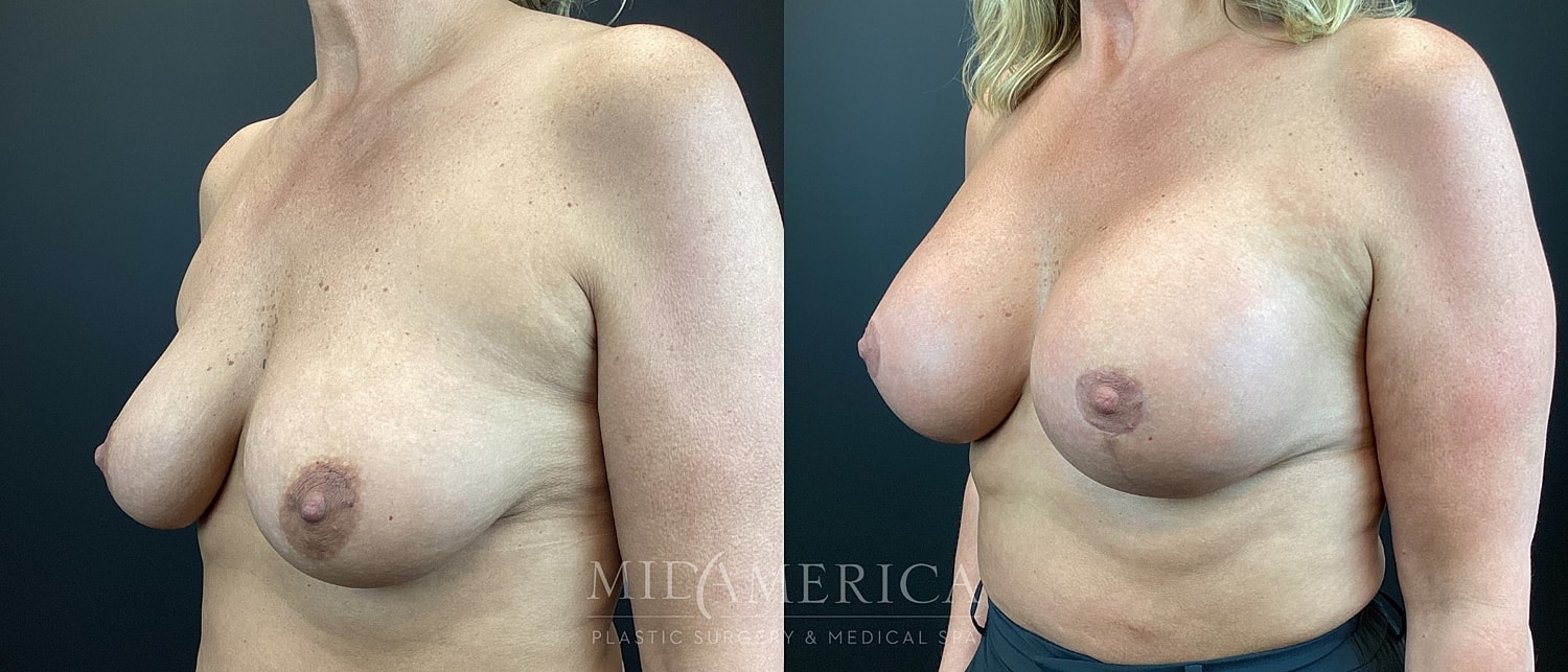 Breast Augmentation & Lift Before & After
