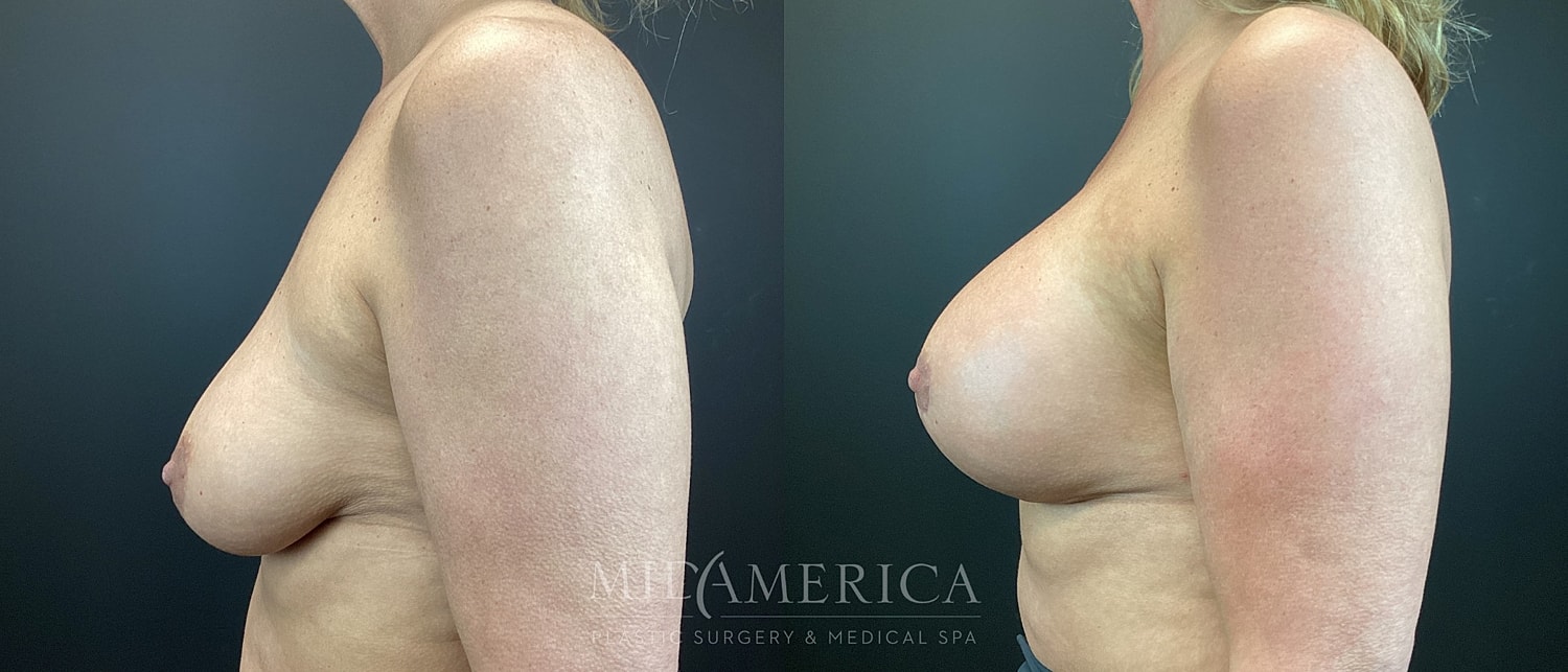 Breast Augmentation & Lift Before & After