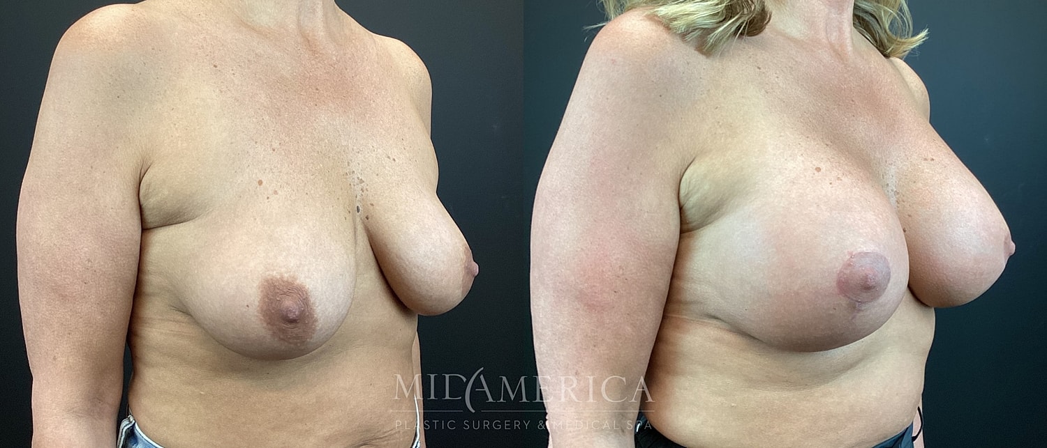Breast Augmentation & Lift Before & After
