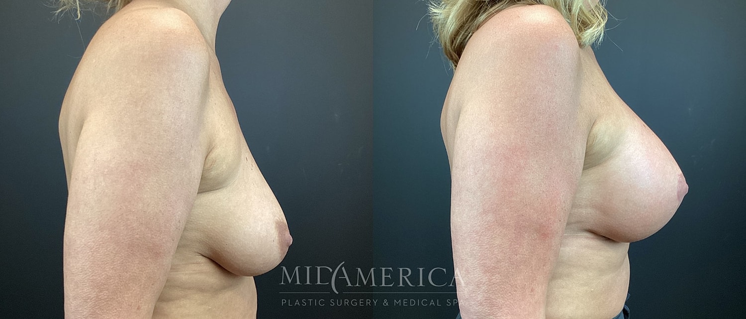 Breast Augmentation & Lift Before & After