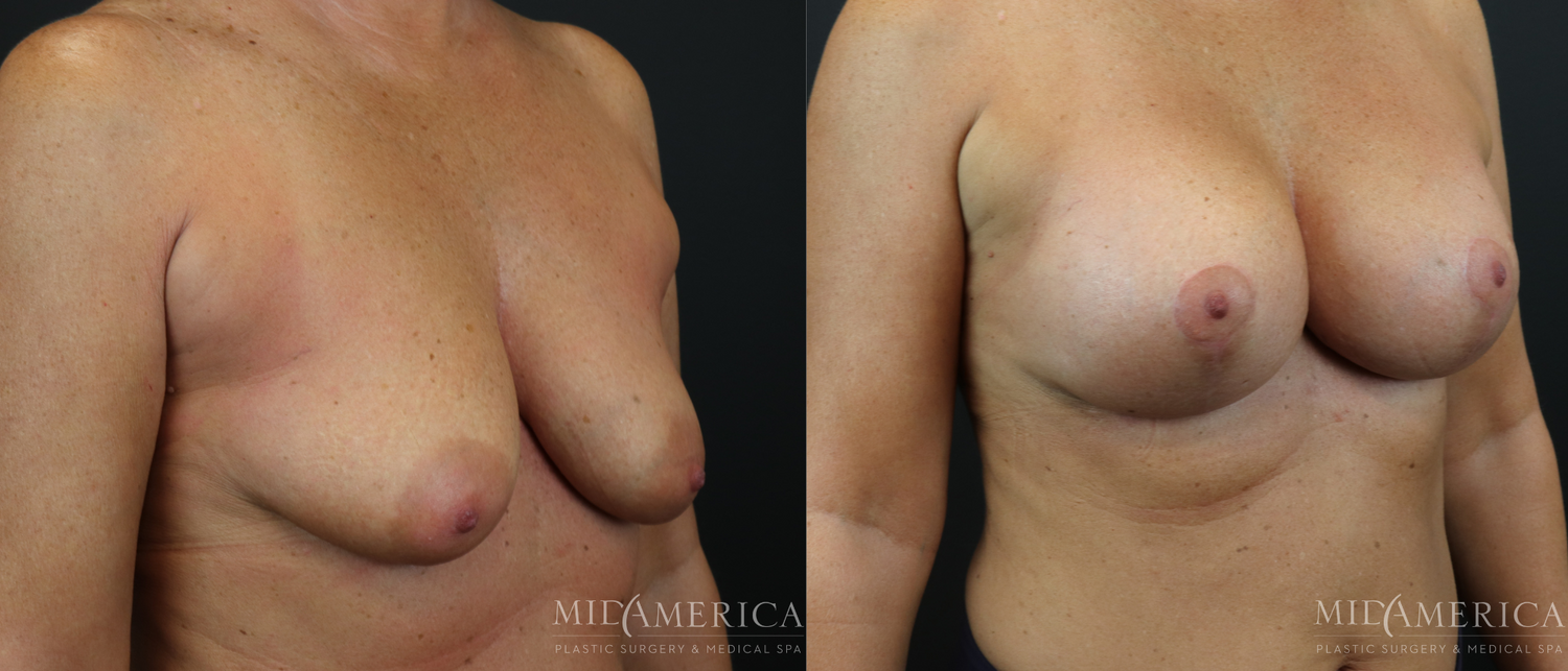 Breast Augmentation & Lift Before & After