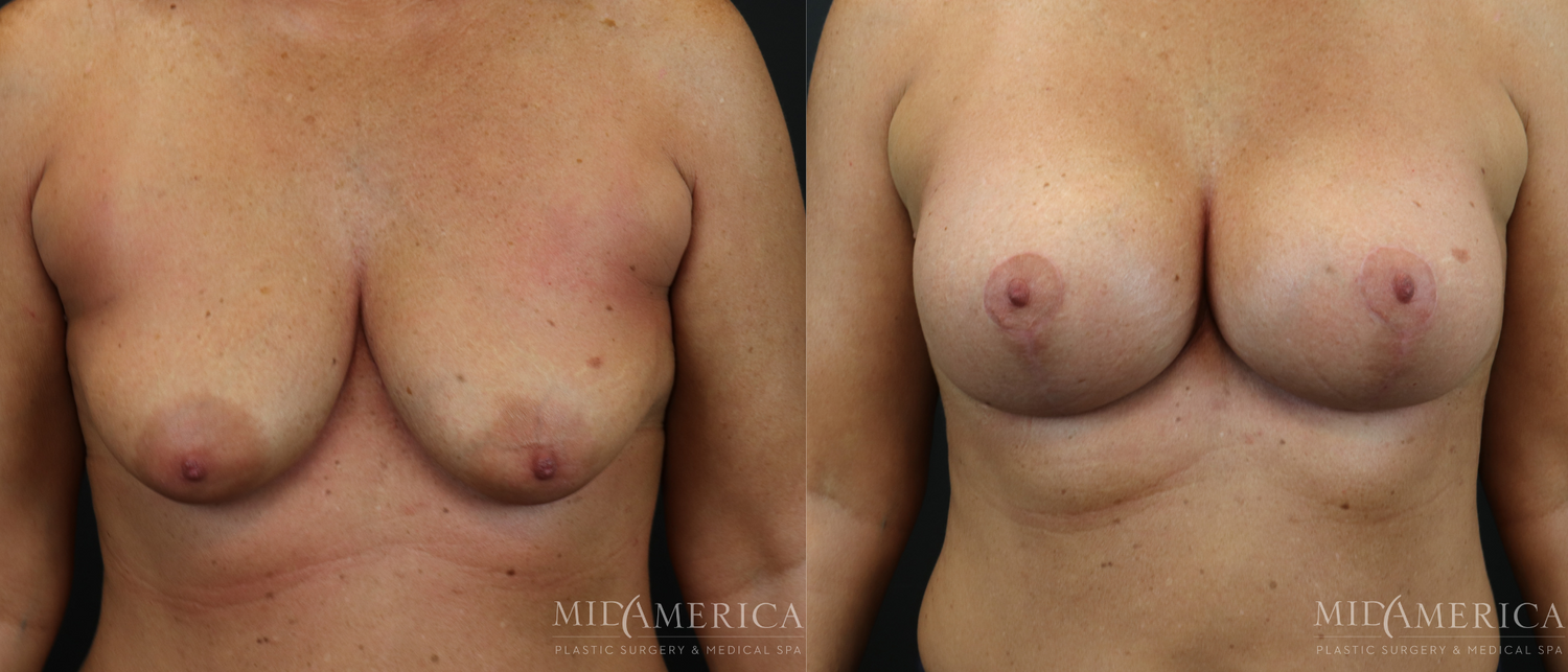 Breast Augmentation & Lift Before & After