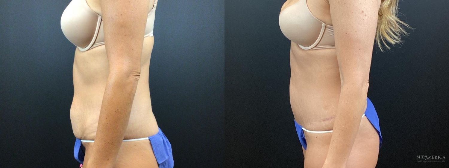 Tummy Tuck Before & After
