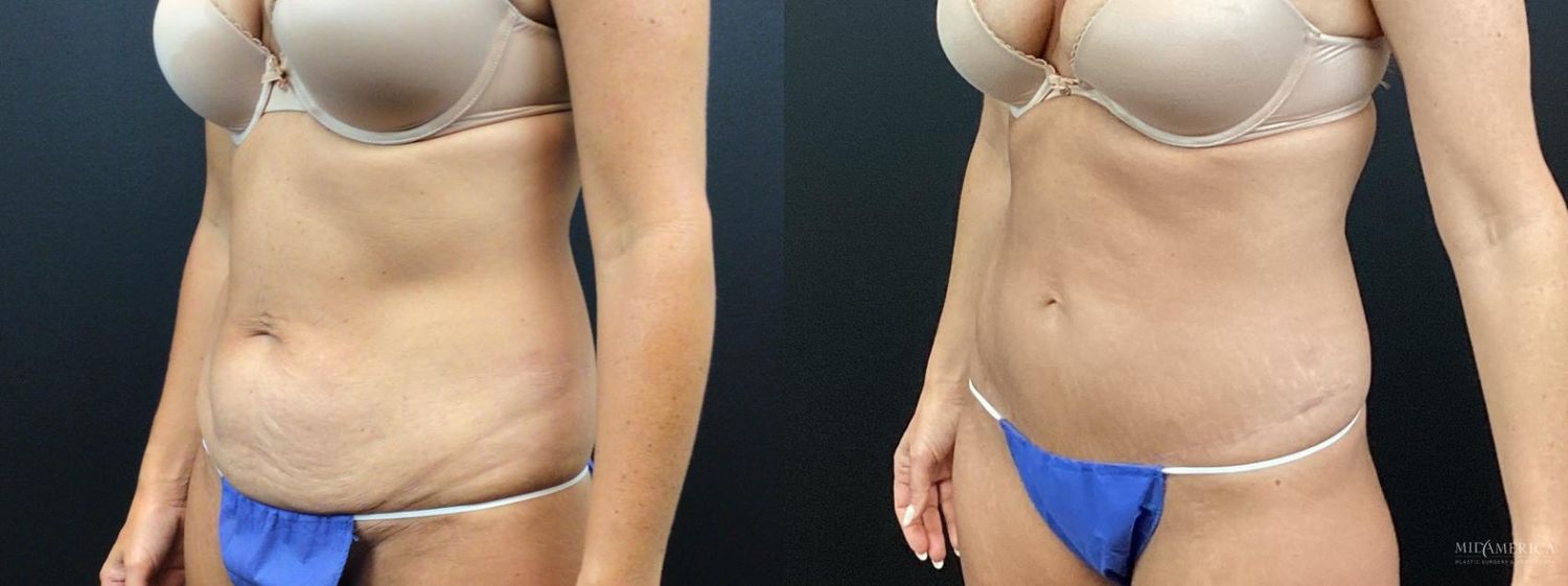 Tummy Tuck Before & After
