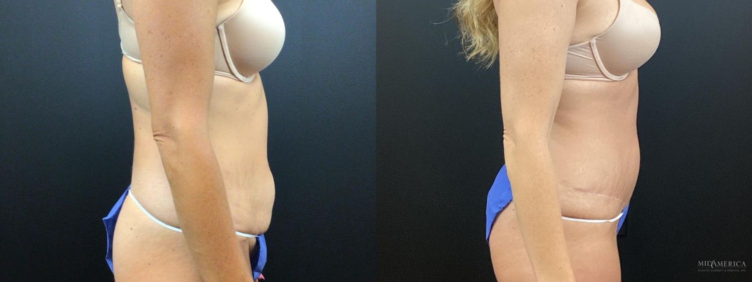 Tummy Tuck Before & After