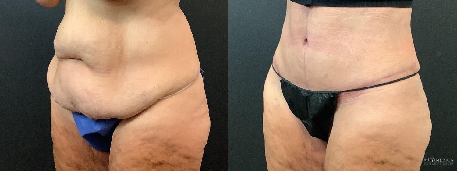 Tummy Tuck Before & After