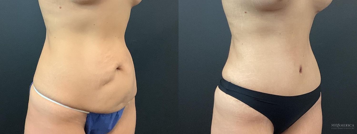 Tummy Tuck Before & After