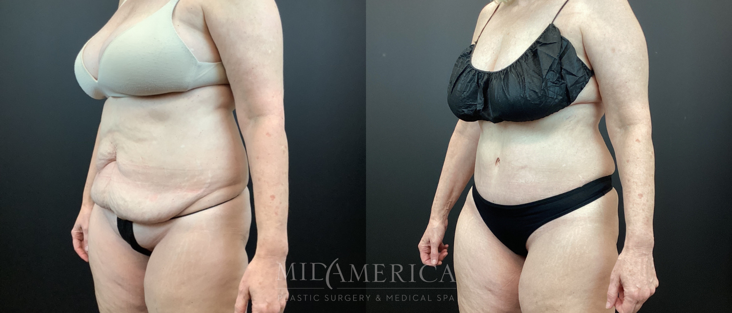 Tummy Tuck Before & After