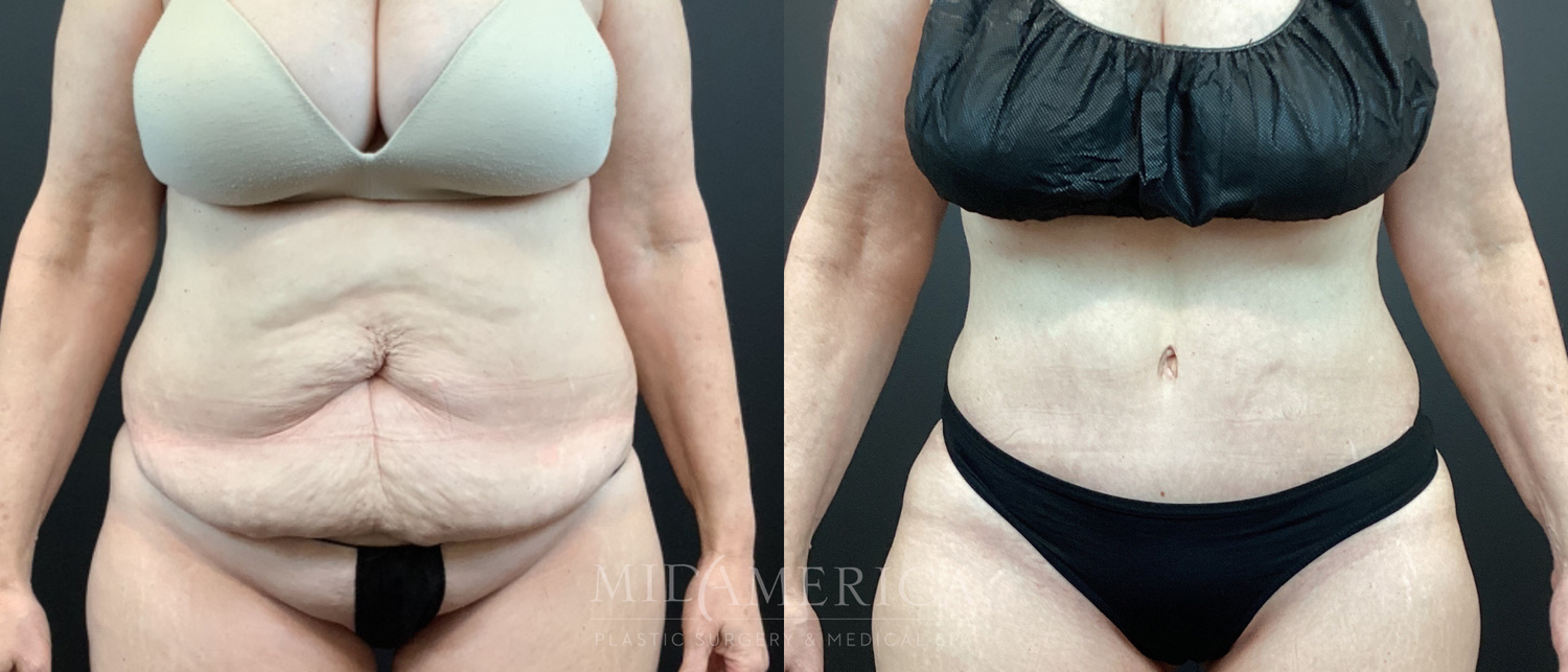 Tummy Tuck Before & After