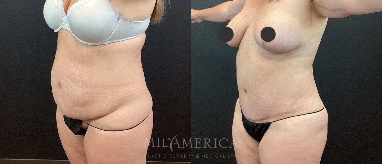 Tummy Tuck Before & After