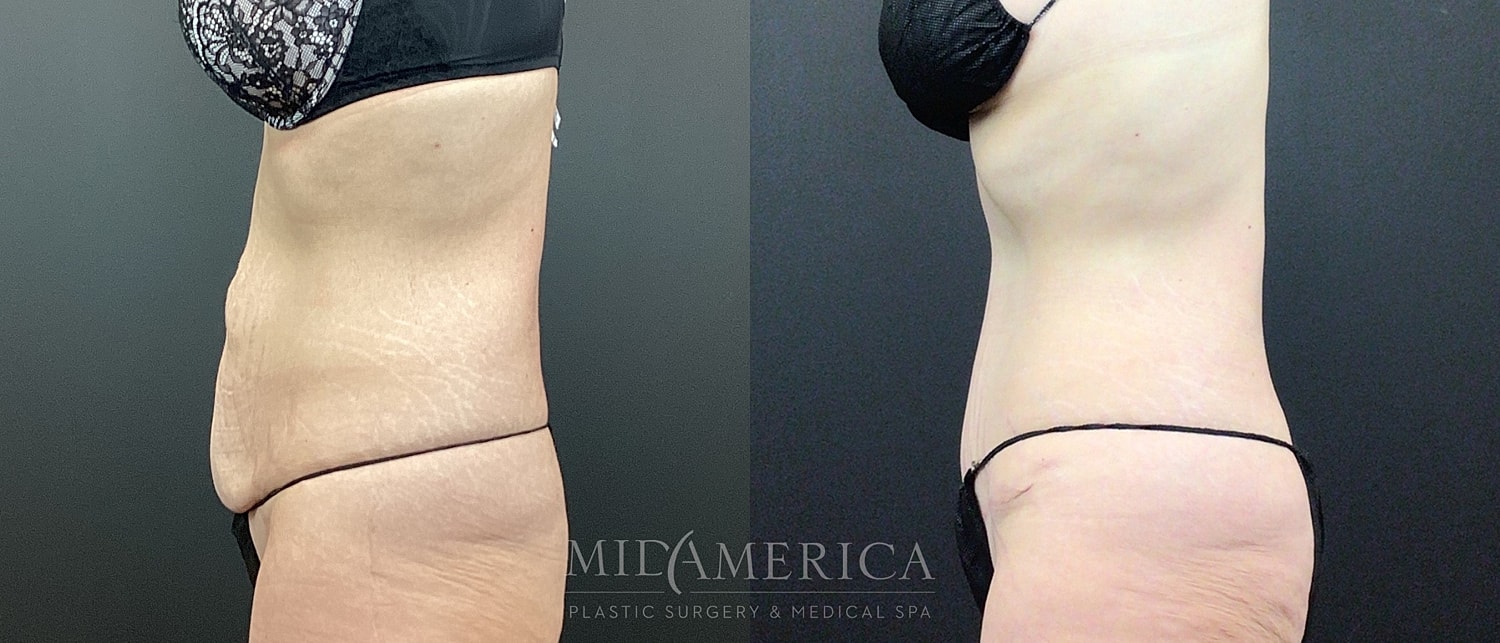Tummy Tuck Before & After