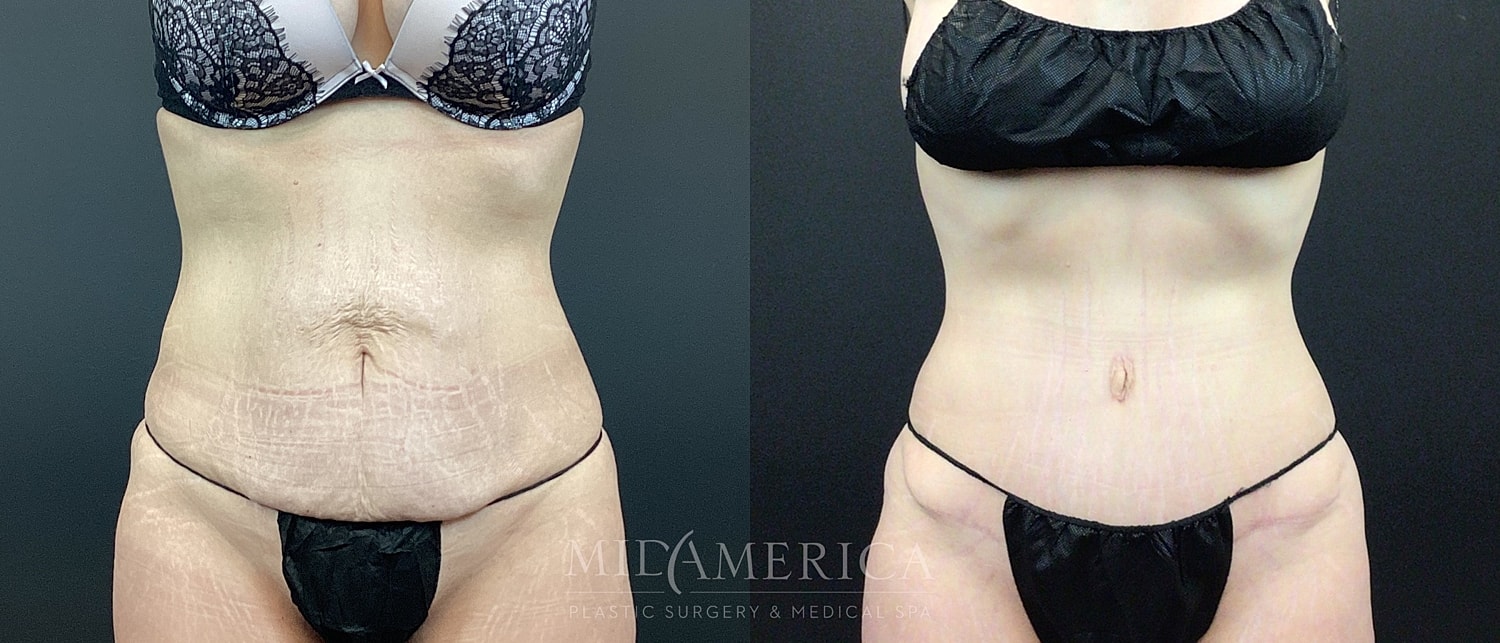 Tummy Tuck Before & After