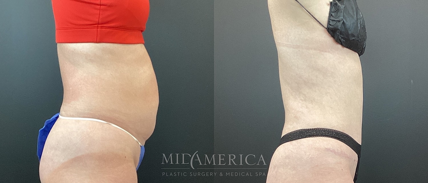 Tummy Tuck Before & After