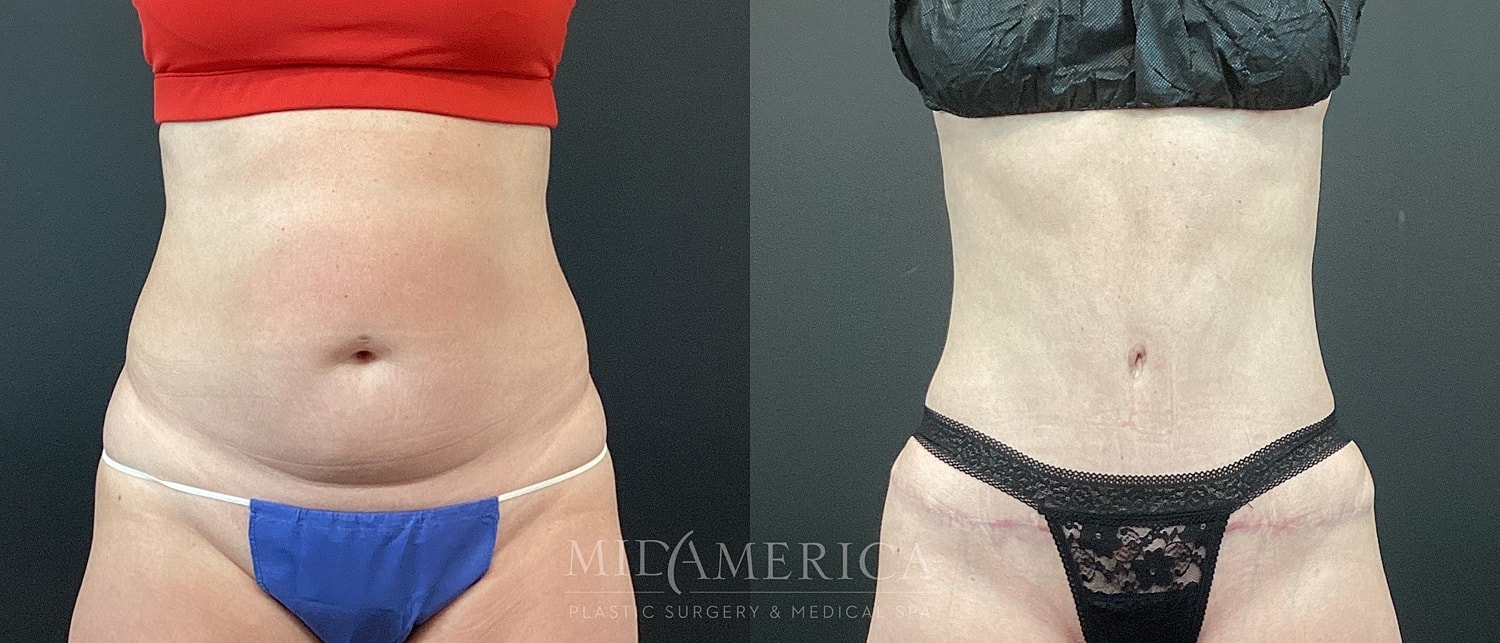 Tummy Tuck Before & After