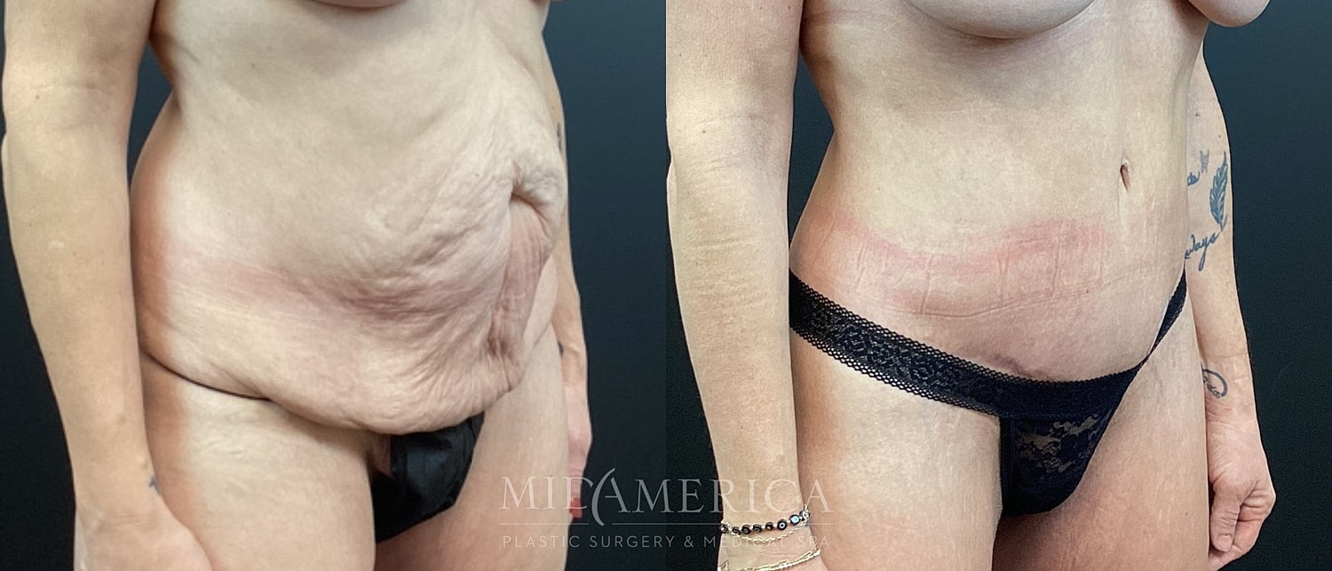 Tummy Tuck Before & After
