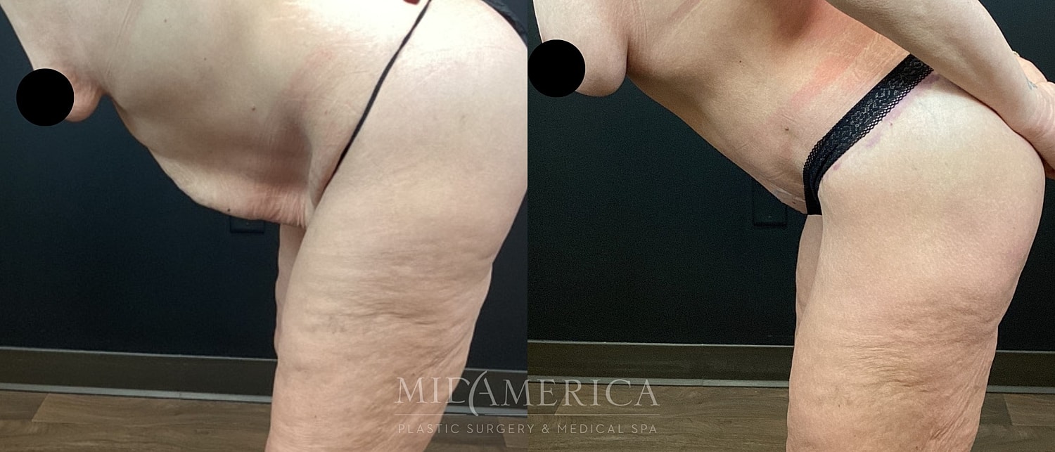 Tummy Tuck Before & After