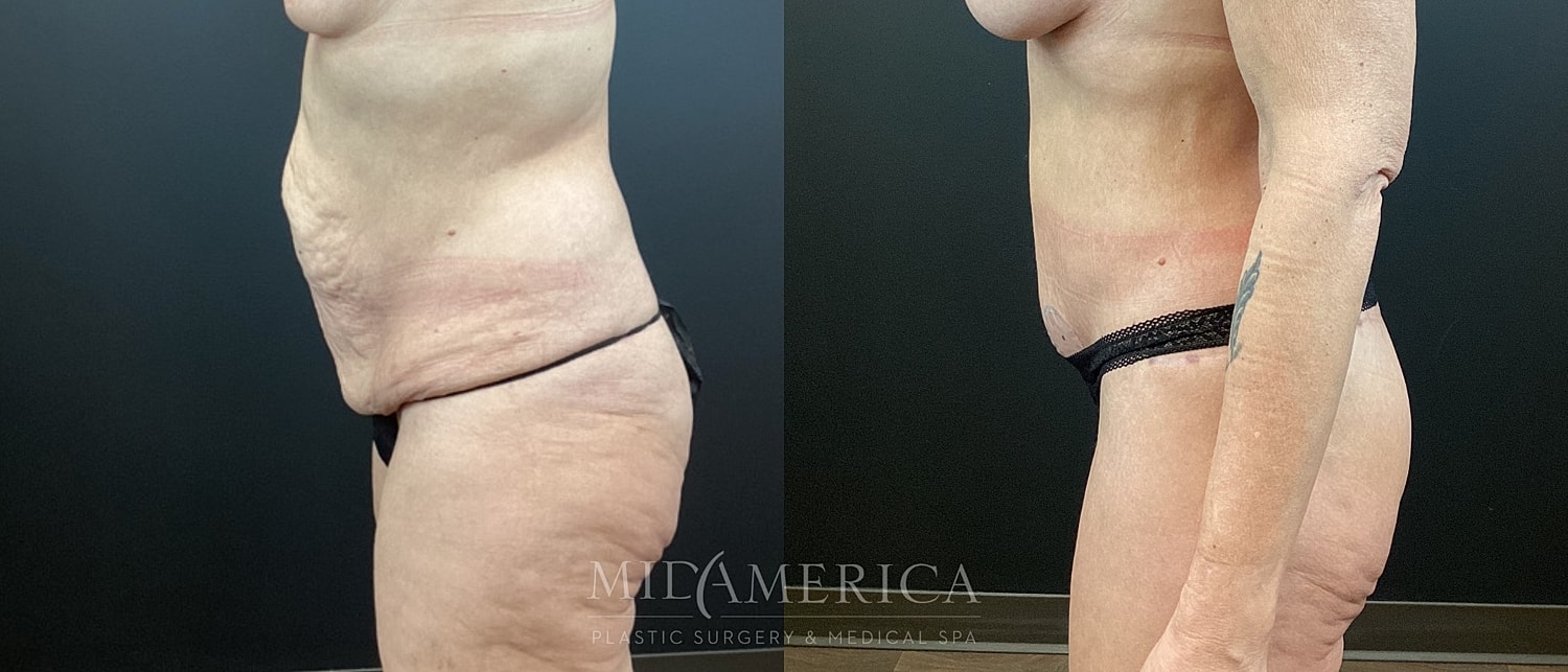 Tummy Tuck Before & After