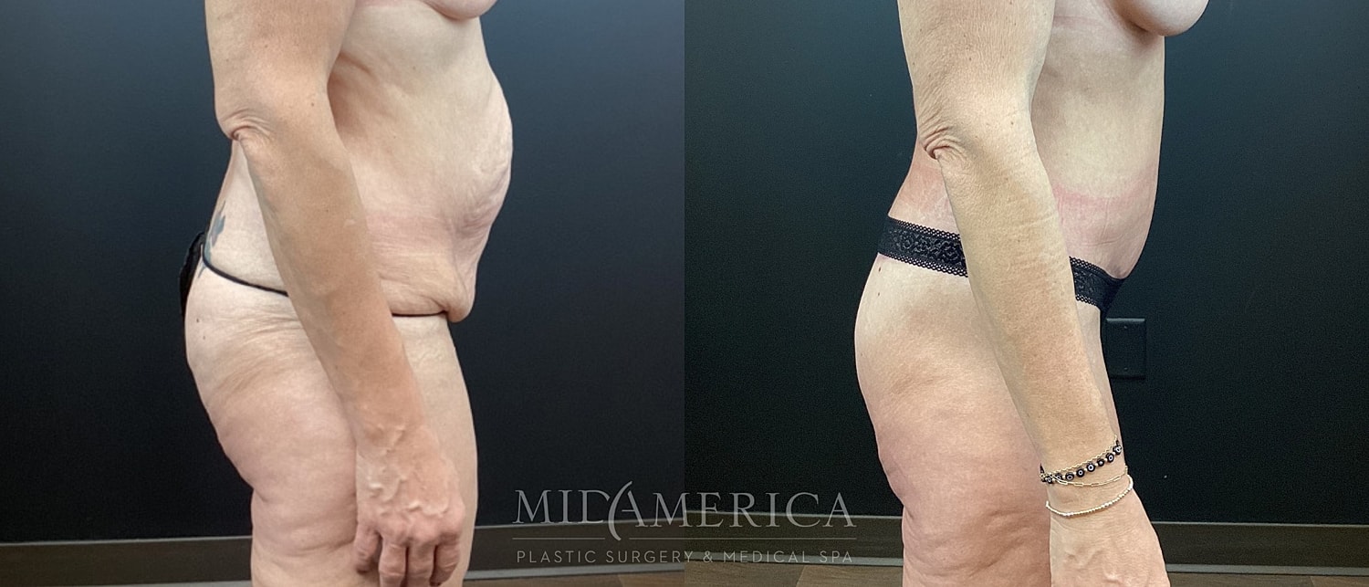 Tummy Tuck Before & After