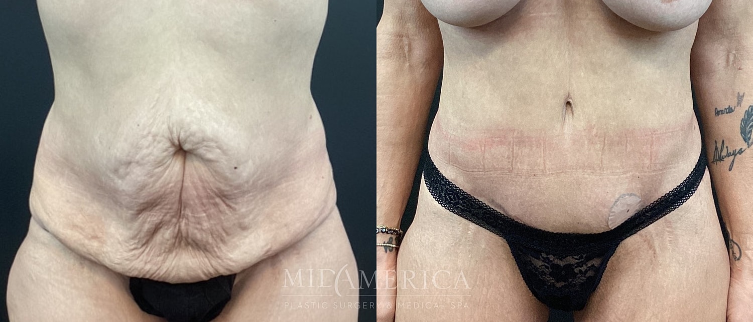 Tummy Tuck Before & After