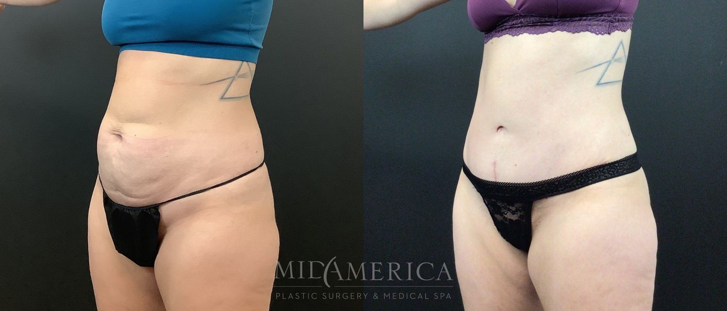 Tummy Tuck Before & After