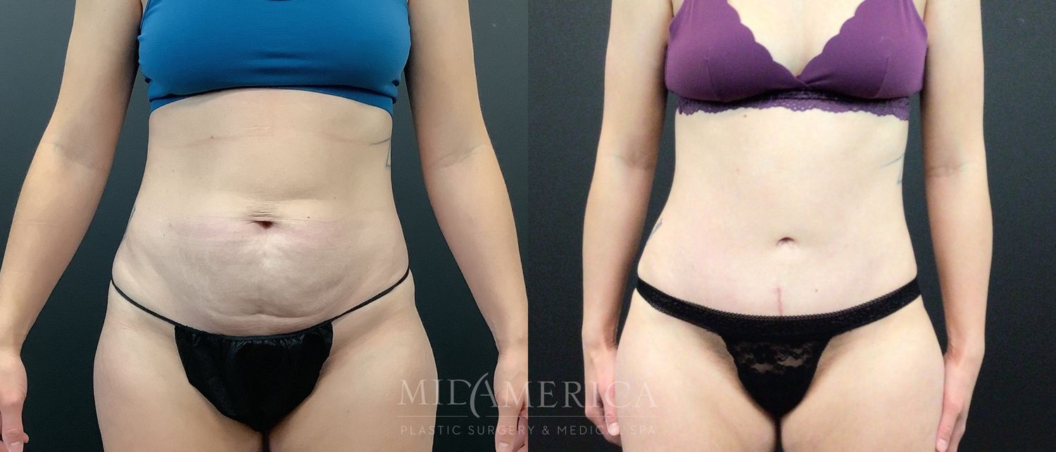 Tummy Tuck Before & After