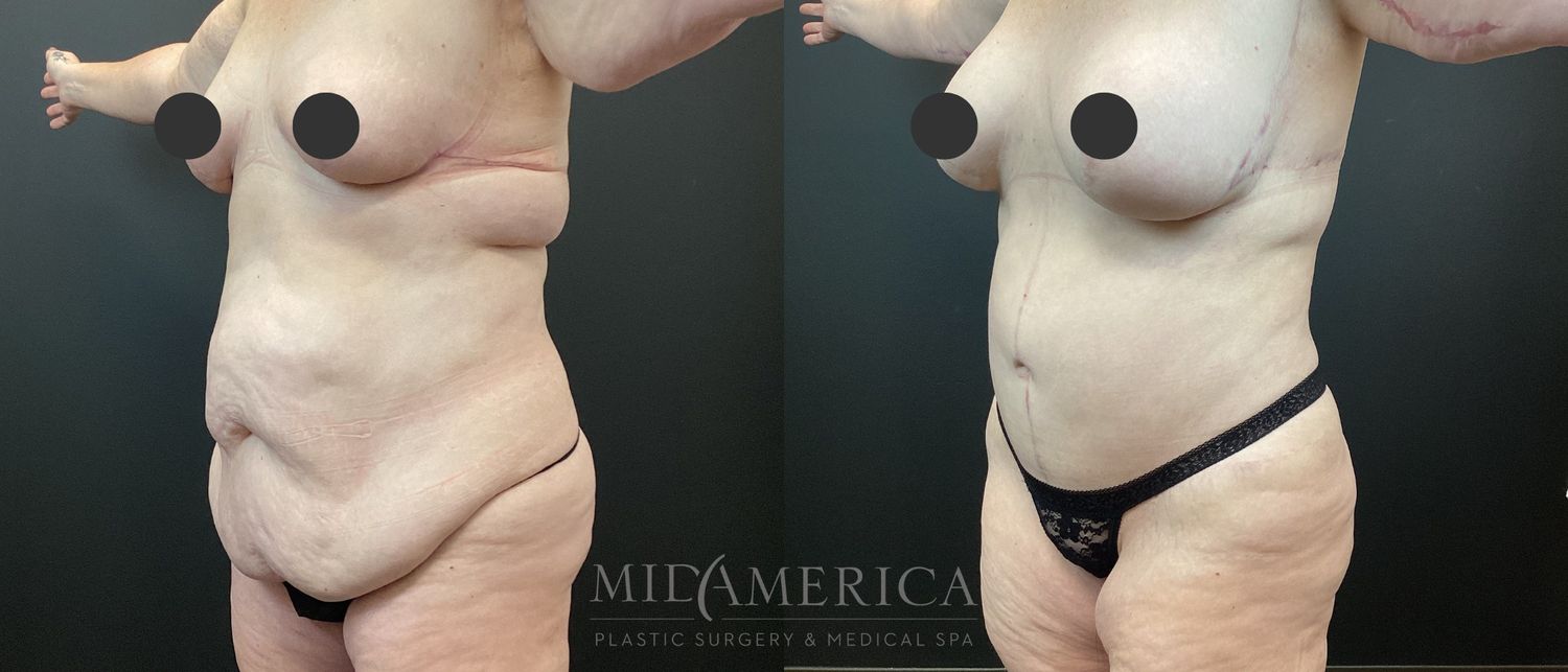 Tummy Tuck Before & After