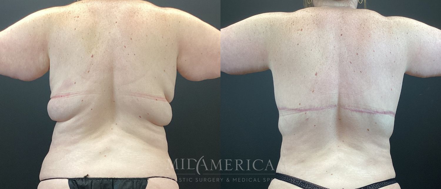 Tummy Tuck Before & After